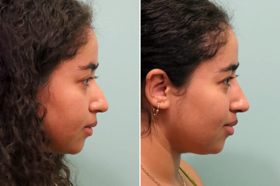 Kết quả trước và sau tiêm filler mũi: Dáng mũi cải thiện tức thì, không phẫu thuật