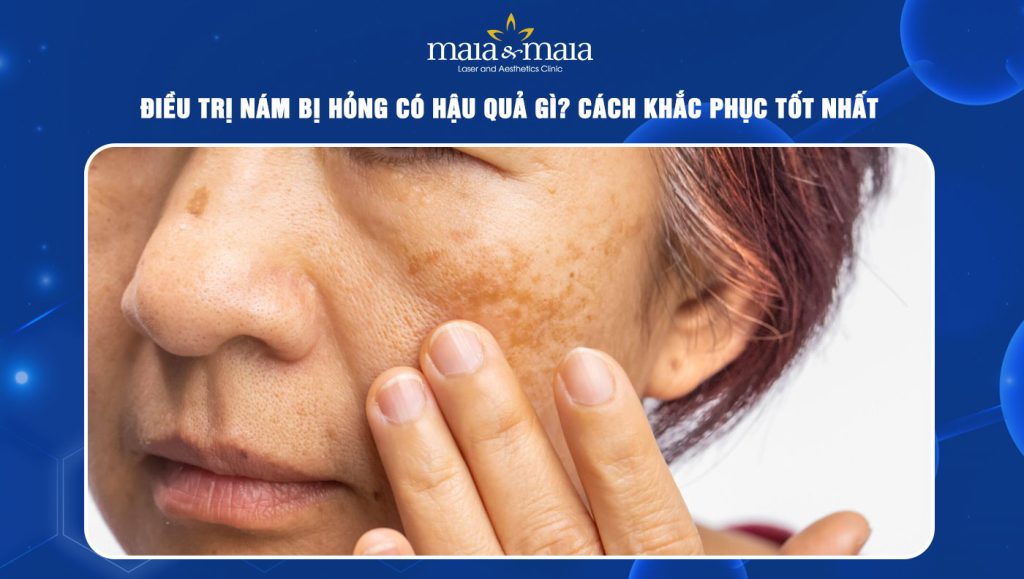 Một trường hợp điều trị nám da bị hỏng do tin tưởng vào các cam kết thiếu cơ sở khoa học