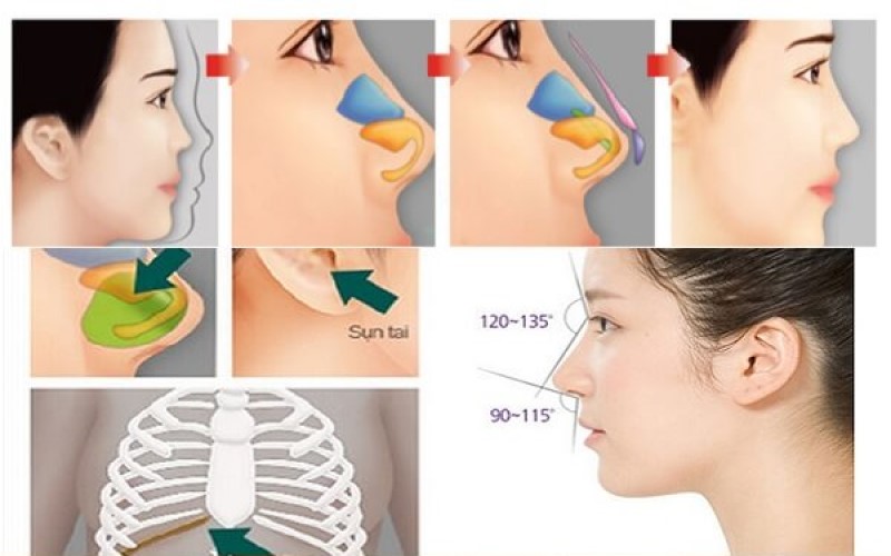 Minh họa phương pháp nâng mũi bằng sụn tự thân an toàn