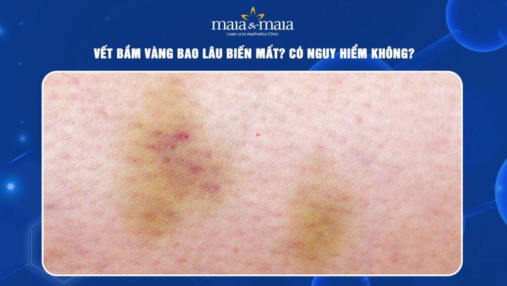 Quá trình chuyển màu của vết bầm vàng sau bóc mỡ mắt mí dưới