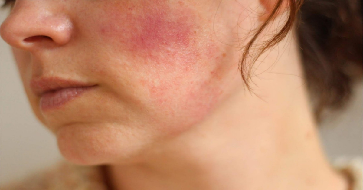 7 Dấu hiệu da nhạy cảm bị kích ứng: Hướng dẫn từ chuyên gia