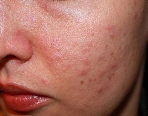 Stress Làm Da Sạm Mụn: Góc Nhìn Đông Y về Can Khí Uất Kết