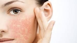 Quy trình phục hồi da nhạy cảm bị kích ứng do dưỡng sáng