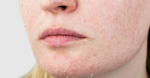 6 Sai Lầm Tai Hại Khi Chăm Sóc DA SAU TREATMENT