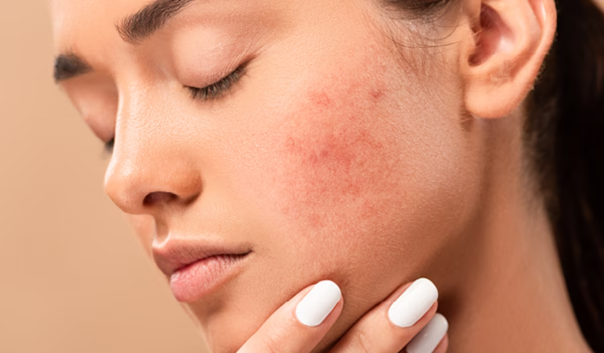 DA SAU TREATMENT: Cách dùng lại hoạt chất an toàn