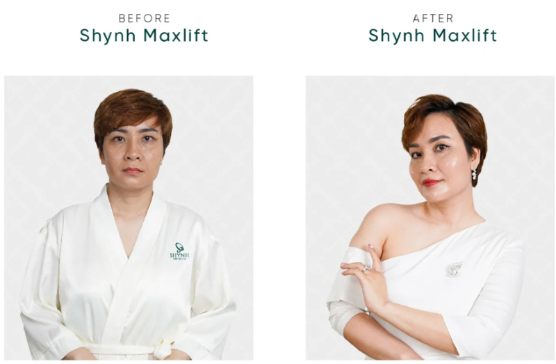 GIẢM NHĂN – NÂNG CƠ: Giải pháp trẻ hóa da an toàn, bền vững