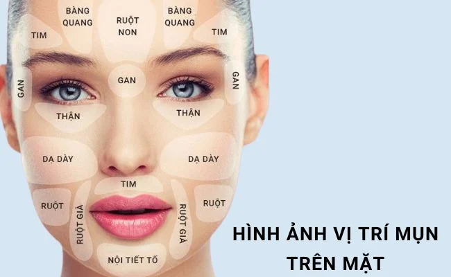 Mụn mùa nóng: Do nóng trong hay bít tắc lỗ chân lông?
