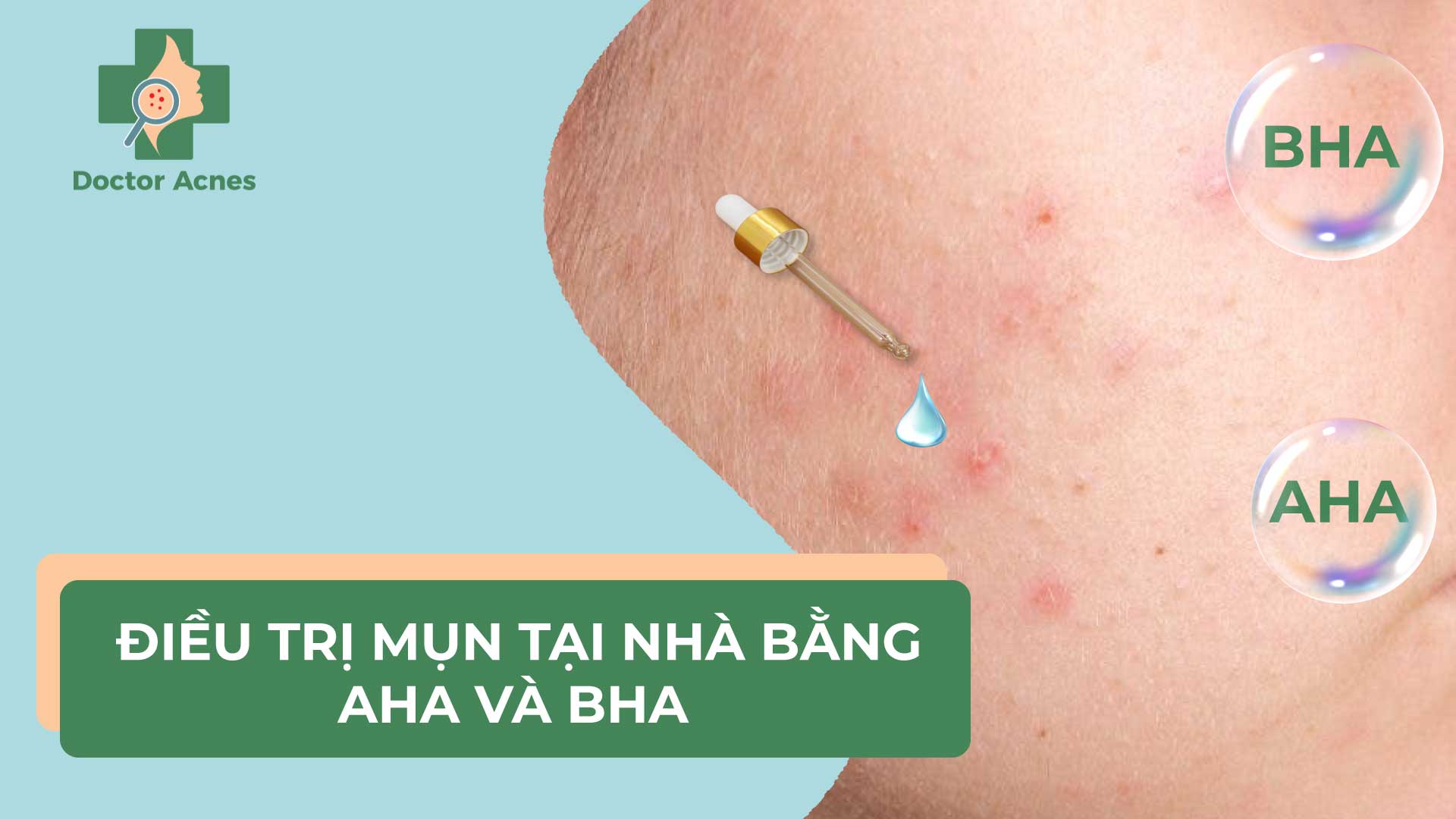 Da mụn và cách xử lý vào mùa nóng: AHA hay BHA?