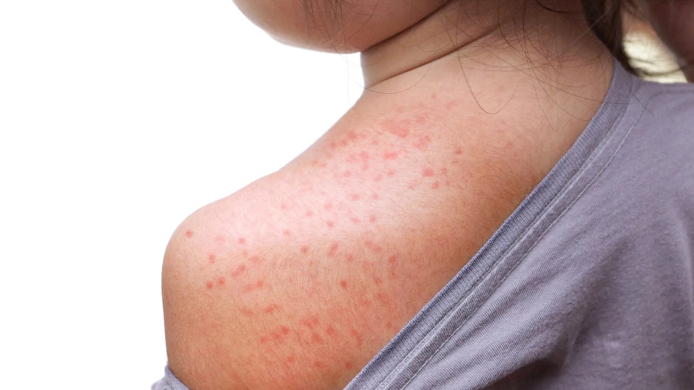 Da mụn và cách xử lý vào mùa nóng: Cách làm mát da