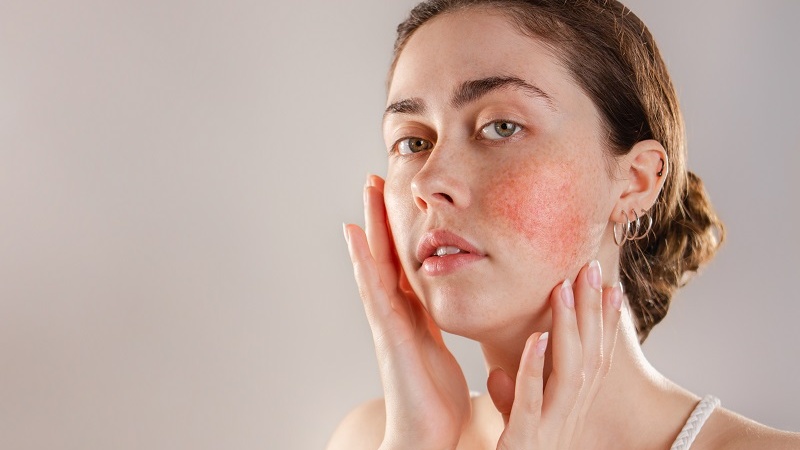 Stress gây mụn: Giải mã liên kết não-da theo Đông y