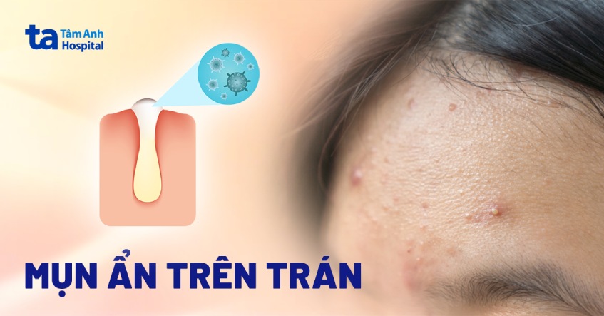 Da mụn và cách xử lý vào mùa nóng: Phân biệt nguyên nhân