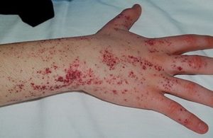 Phục hồi da nhiễm corticoid: Khi nào dùng mỹ phẩm an toàn?