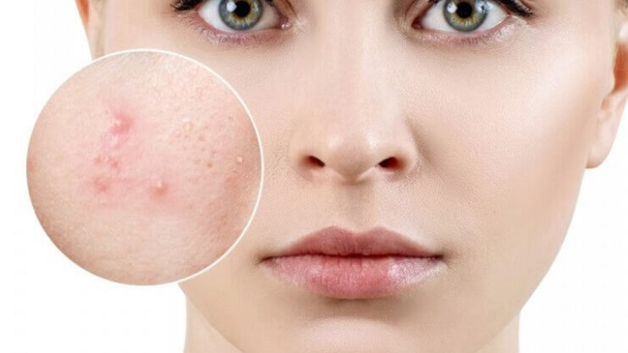 Da mụn và cách xử lý vào mùa nóng: Quy trình an toàn