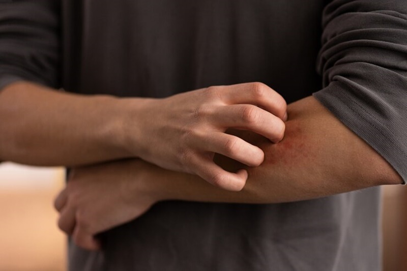 Phân biệt da kích ứng và dị ứng: Bí quyết chăm sóc da chuẩn